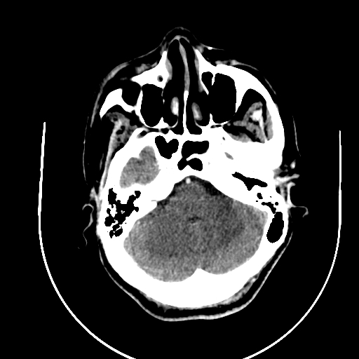 Chronic invasive fungal sinusitis (Radiopaedia 91563-109286 B 19).jpg