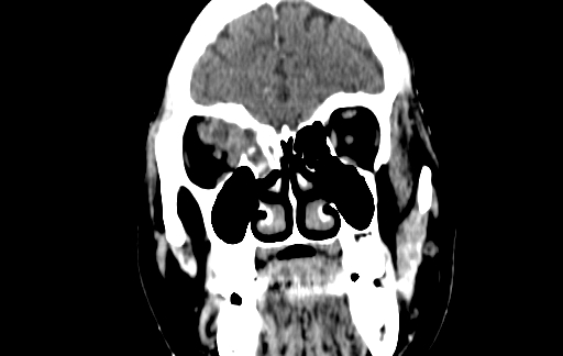 Chronic invasive fungal sinusitis (Radiopaedia 91563-109286 D 31).jpg