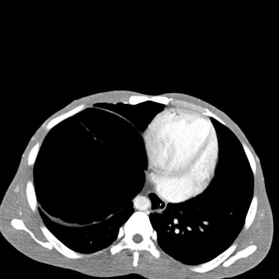 Chronic large bowel pseudo-obstruction (Radiopaedia 43181-46492 A 26).jpg
