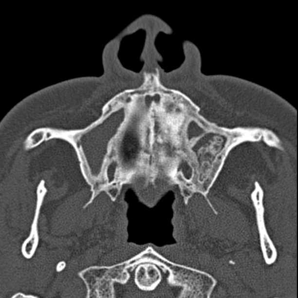 Chronic maxillary sinusitis (Radiopaedia 27879-28116 Axial bone window 8).jpg