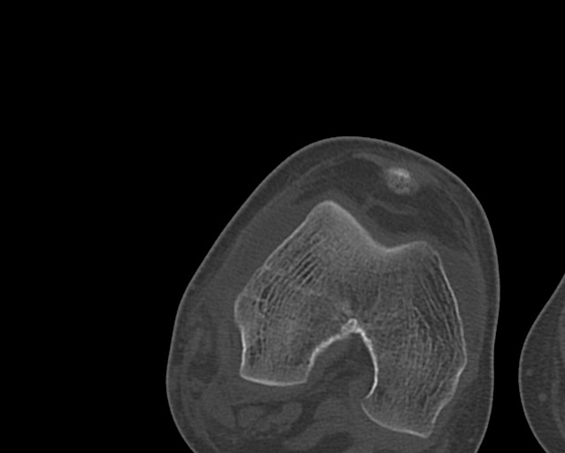 Chronic ostemyelitis of the femur with long sinus tract (Radiopaedia 74947-85982 Axial bone window 219).jpg