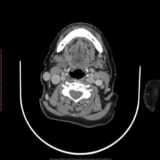 File:Chronic osteomyelitis - maxilla (Radiopaedia 23783-23927 B 1).jpg