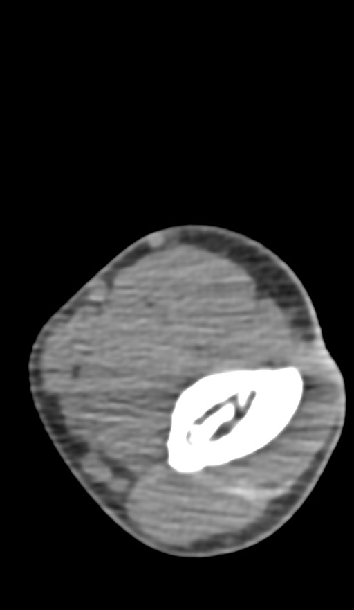 Chronic osteomyelitis of the distal humerus (Radiopaedia 78351-90971 Axial non-contrast 75).jpg