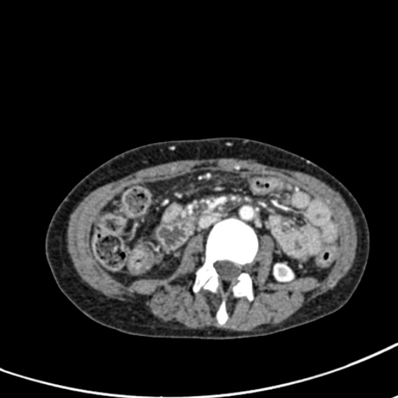 Chronic pancreatitis (Radiopaedia 55405-61846 A 53).jpg