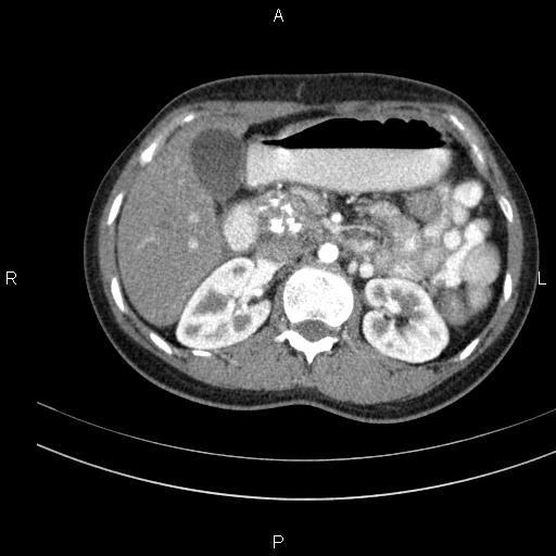 File:Chronic pancreatitis (Radiopaedia 64576-73450 B 55).jpg