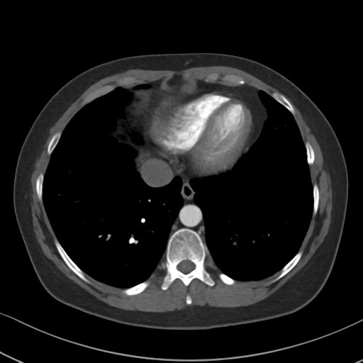 File:Chronic pulmonary embolus (Radiopaedia 39129-41341 Axial C+ CTPA 77).png