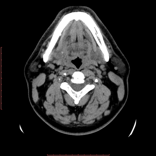File:Chronic submandibular sialolithiasis (Radiopaedia 69817-79814 Axial non-contrast 108).jpg