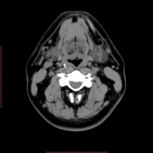 Chronic submandibular sialolithiasis (Radiopaedia 69817-79814 Axial non-contrast 121).jpg