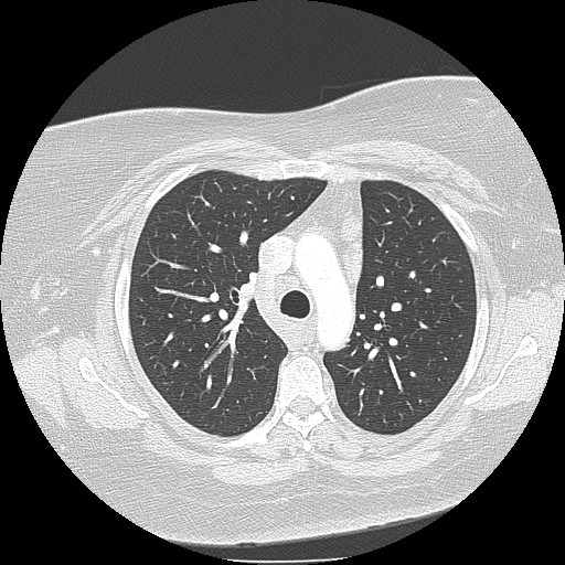 File:Cicatrisation collapse (Radiopaedia 17405-17089 lung window 39).jpg