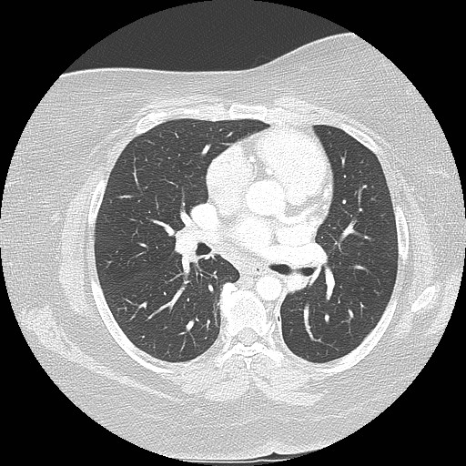 Cicatrisation collapse (Radiopaedia 17405-17089 lung window 55).jpg