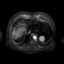File:Cirrhosis and hepatocellular carcinoma in the setting of hemochromatosis (Radiopaedia 75394-86594 Axial T1 C+ fat sat 152).jpg