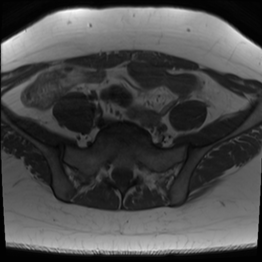 File:Class II Mullerian duct anomaly- unicornuate uterus with rudimentary horn and non-communicating cavity (Radiopaedia 39441-41755 Axial T1 4).jpg