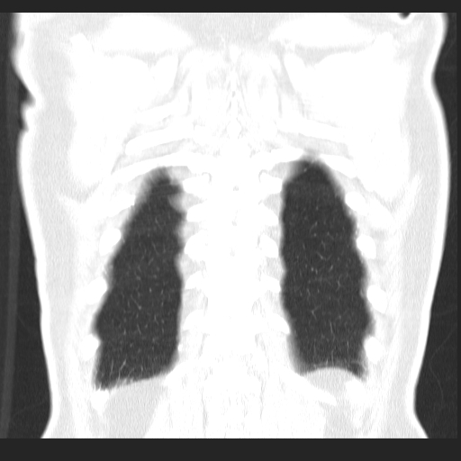 File:Classic complicated silicosis (Radiopaedia 49720-54961 Coronal lung window 57).jpg