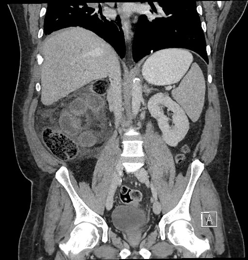 Closed loop obstruction - internal hernia into nephrectomy bed (Radiopaedia 59867-67320 B 81).jpg
