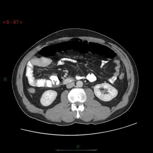 File:Closed loop obstruction and appendicular stump mucocele (Radiopaedia 54014-60163 A 53).jpg