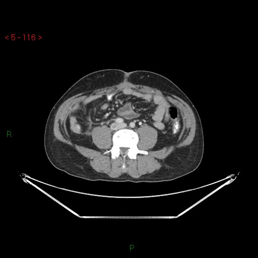 Closed loop obstruction and appendicular stump mucocele (Radiopaedia 54014-61158 A 48).jpg