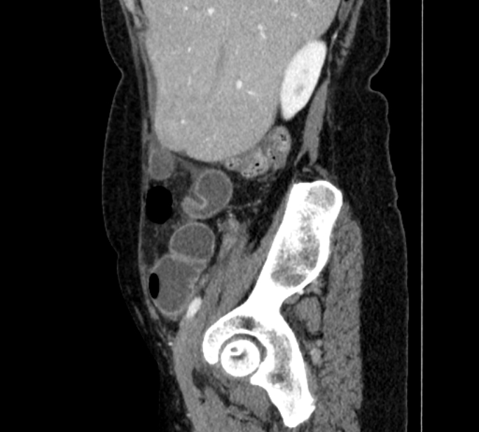 Closed loop small bowel obstruction (Radiopaedia 71211-81508 C 20).jpg