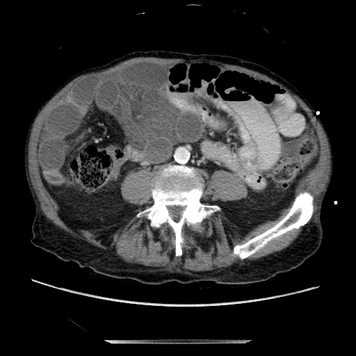 Closed loop small bowel obstruction - adhesive disease and hemorrhagic ischemia (Radiopaedia 86831-102990 A 116).jpg