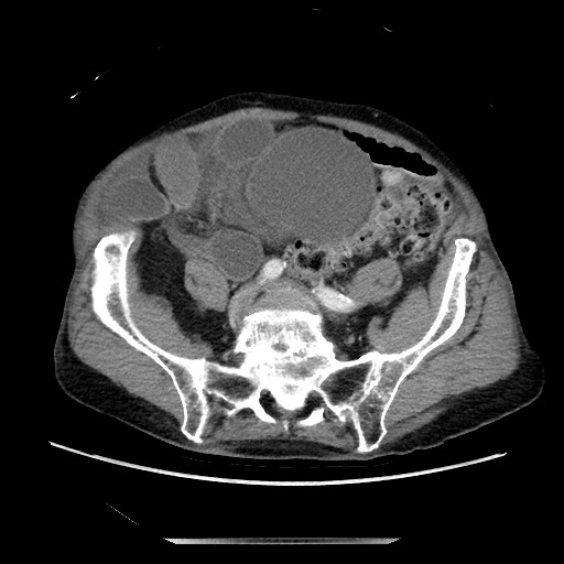 Closed loop small bowel obstruction - adhesive disease and hemorrhagic ischemia (Radiopaedia 86831-102990 A 133).jpg