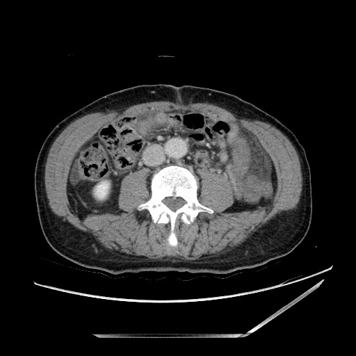 Closed loop small bowel obstruction - omental adhesion causing "internal hernia" (Radiopaedia 85129-100682 A 93).jpg