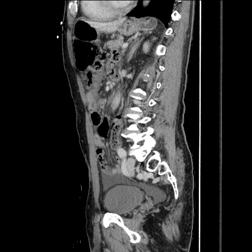 Closed loop small bowel obstruction - omental adhesion causing "internal hernia" (Radiopaedia 85129-100682 C 109).jpg