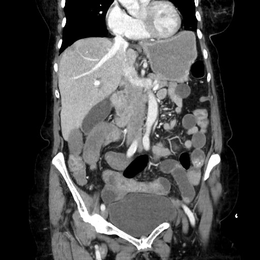 Closed loop small bowel obstruction due to adhesive band, with intramural hemorrhage and ischemia (Radiopaedia 83831-99017 C 55).jpg