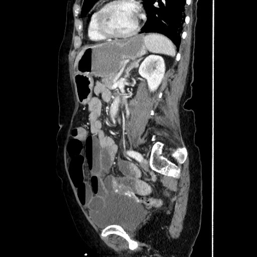 Closed loop small bowel obstruction due to adhesive band, with intramural hemorrhage and ischemia (Radiopaedia 83831-99017 D 122).jpg
