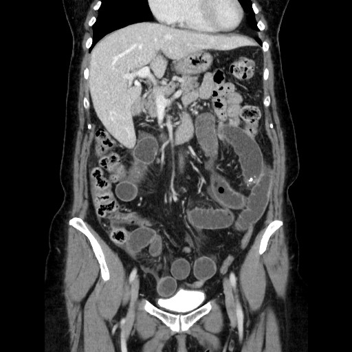 File:Closed loop small bowel obstruction due to adhesive bands - early and late images (Radiopaedia 83830-99015 B 50).jpg
