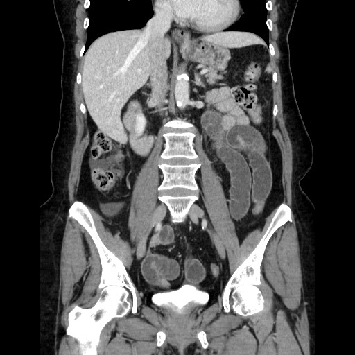 Closed loop small bowel obstruction due to adhesive bands - early and late images (Radiopaedia 83830-99015 B 67).jpg