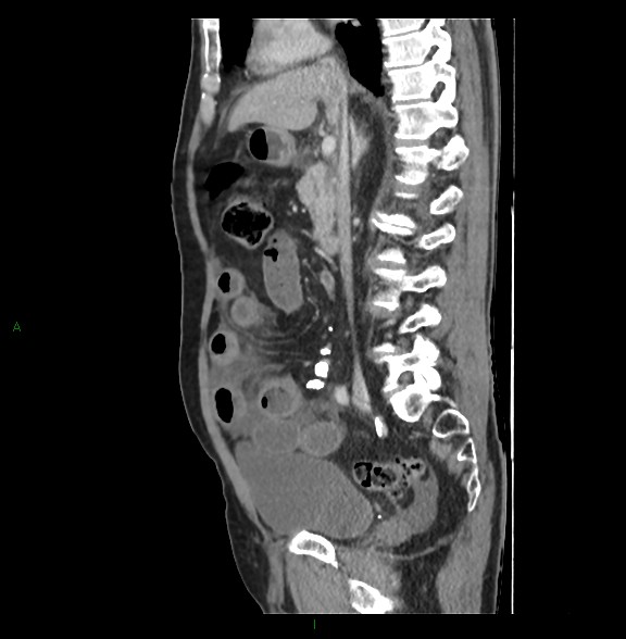 Closed loop small bowel obstruction with ischemia (Radiopaedia 84180-99456 C 41).jpg