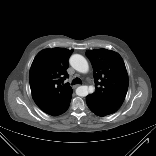 File:Coarctation of the aorta (Radiopaedia 17427-17116 B 24).jpg