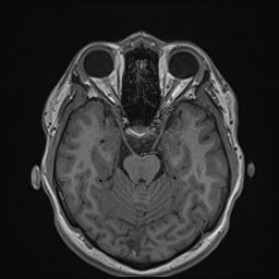 Cochlear incomplete partition type III associated with hypothalamic hamartoma (Radiopaedia 88756-105498 Axial T1 79).jpg