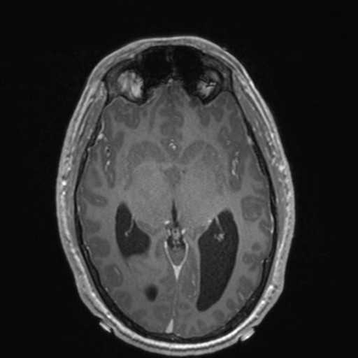 File:Colloid cyst (Radiopaedia 44510-48181 Axial T1 C+ 86).png