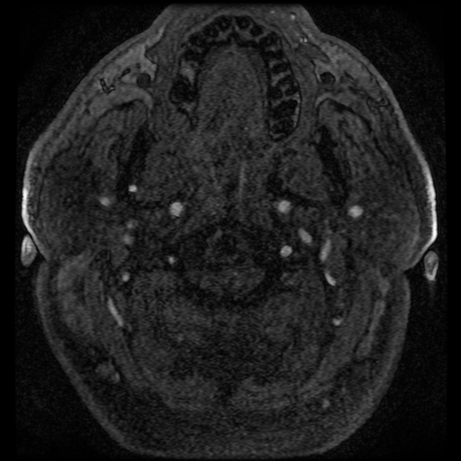 File:Colloid cyst with anterior communicating artery aneurysm (Radiopaedia 33901-35091 Axial MRA 9).jpg