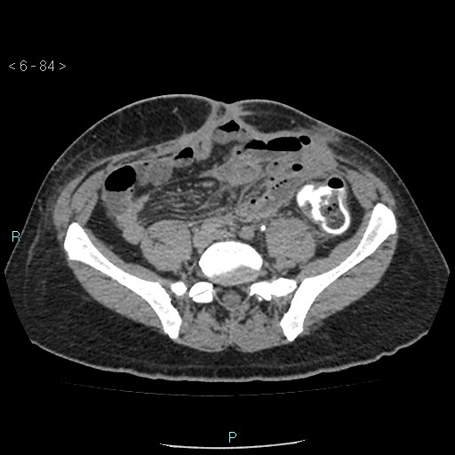Colo-cutaneous fistula (Radiopaedia 40531-43129 A 35).jpg