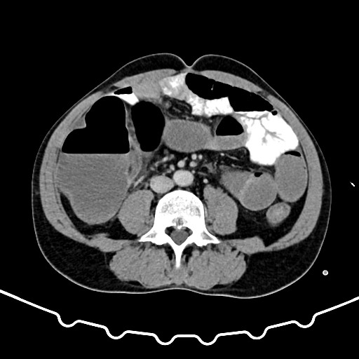 Colocolic intussusception due to large lipoma (Radiopaedia 68773-78482 A 109).jpg