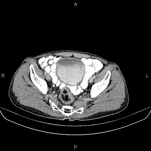 File:Colon adenocarcinoma - hepatic flexure (Radiopaedia 85635-101395 Axial C+ delayed 81).jpg