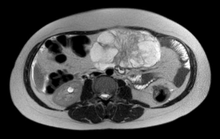 Colon adenocarcinoma with Krukenberg tumors, advanced pregnancy (Radiopaedia 67279-76645 Axial T2 44).jpg
