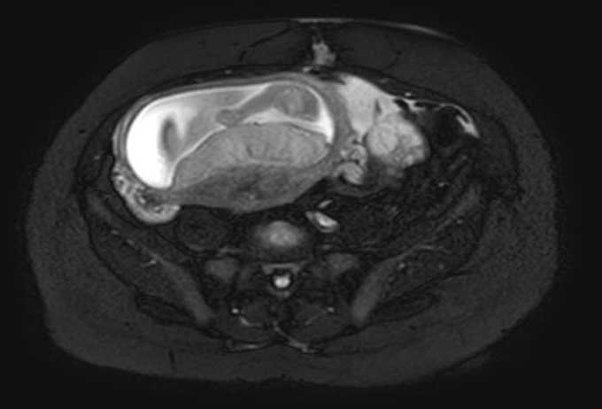 Colon adenocarcinoma with Krukenberg tumors, advanced pregnancy (Radiopaedia 67279-76645 Axial T2 SPAIR 27).jpg