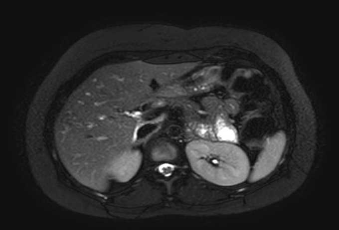 File:Colon adenocarcinoma with Krukenberg tumors, advanced pregnancy (Radiopaedia 67279-76645 Axial T2 SPAIR 61).jpg