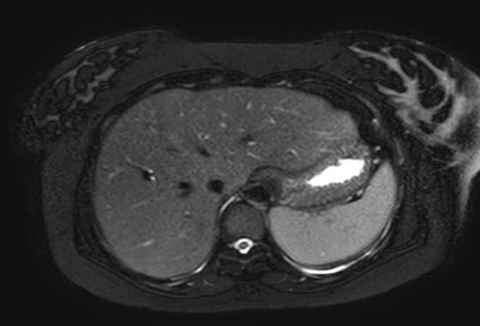 File:Colon adenocarcinoma with Krukenberg tumors, advanced pregnancy (Radiopaedia 67279-76645 Axial T2 SPAIR 73).jpg