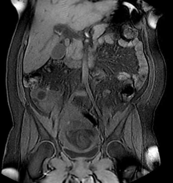 Colon adenocarcinoma with Krukenberg tumors, advanced pregnancy (Radiopaedia 67279-76645 E 45).jpg