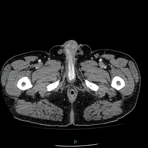 Colon adenocarcinoma with calcific liver metastasis (Radiopaedia 55745-62300 B 53).jpg