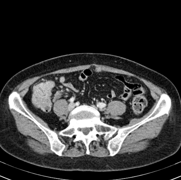 Colon carcinoma with hepatic metastases (Radiopaedia 29477-29961 A 79).jpg