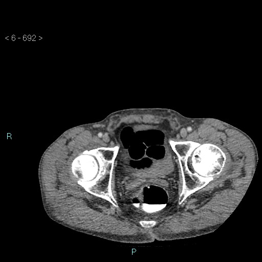 File:Colonic cancer (ultrasound and TC imaging) (Radiopaedia 50346-55713 A 136).jpg