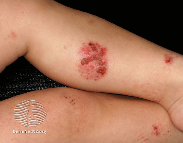 File:Discoid plaques (DermNet NZ dermatitis-s-atopic18).jpg