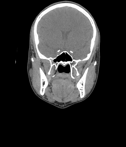 Nasal pyogenic granuloma (lobular capillary hemangioma) (Radiopaedia 85536-101244 Coronal non-contrast 98).jpg