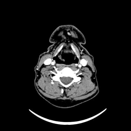 File:Nasopharyngeal carcinoma - infiltrating the clivus (Radiopaedia 62583-70875 Axial Post contrast 49).jpg