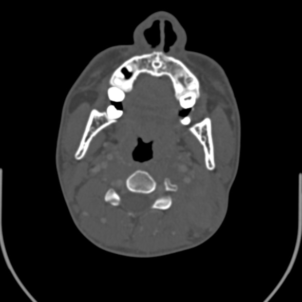 File:Nasopharyngeal carcinoma with skull base invasion (Radiopaedia 53415-59705 Axial bone window 90).jpg