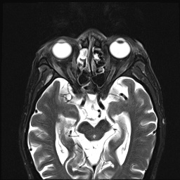 File:Nasopharyngeal carcinoma with skull base invasion (Radiopaedia 59258-66600 D 6).jpg